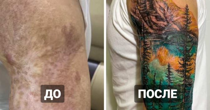 20 tetoválás a hegek és égési sérülések felett, amelyek segítettek az embereknek, hogy a hibáikat kiemeljék