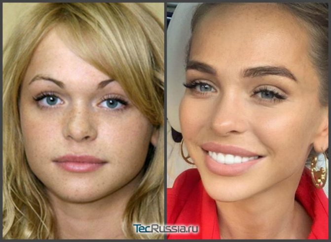 Podstoupila Anna Khilkevichová operaci očních víček?