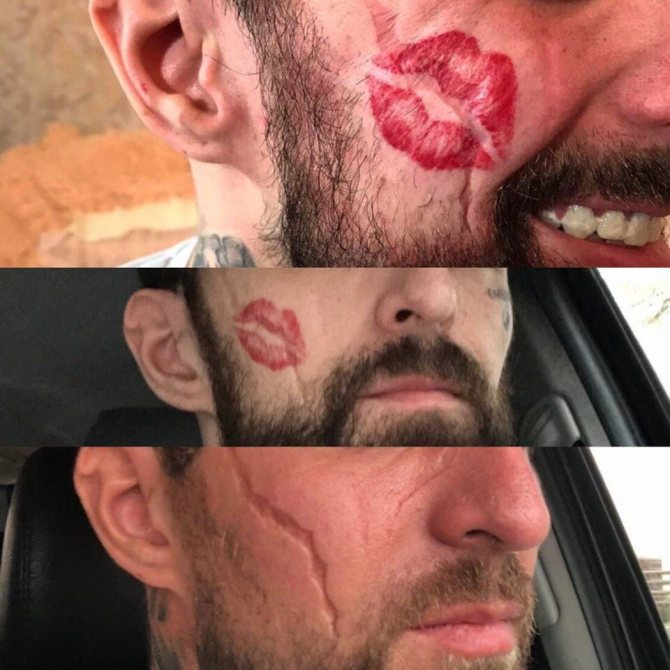 Le tatouage le plus dur disparaît après quelques séances.