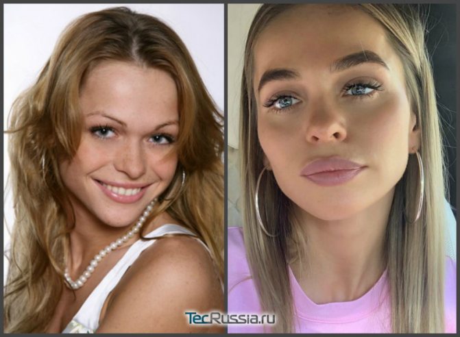 Fotografie Khilkevicha před a po plastické operaci