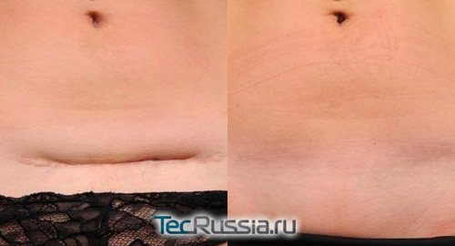 chirurgická léčba břišní jizvy