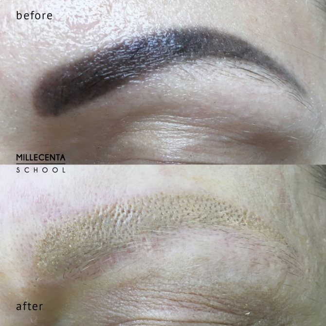 Inversion pigmentaire, photo-post épilation laser des sourcils
