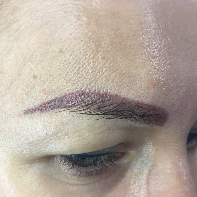 Inversion pigmentaire. Photo-élimination - Processus d'élimination par laser - 1 session