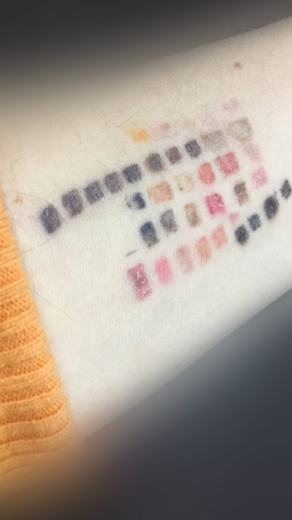 Inversion pigmentaire. Photo du processus de guérison après l'ablation au laser