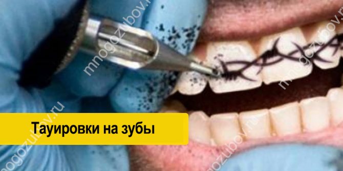 歯にタトゥーを入れるには?