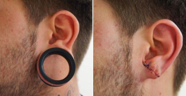 How to make tunnels in the ears care complications