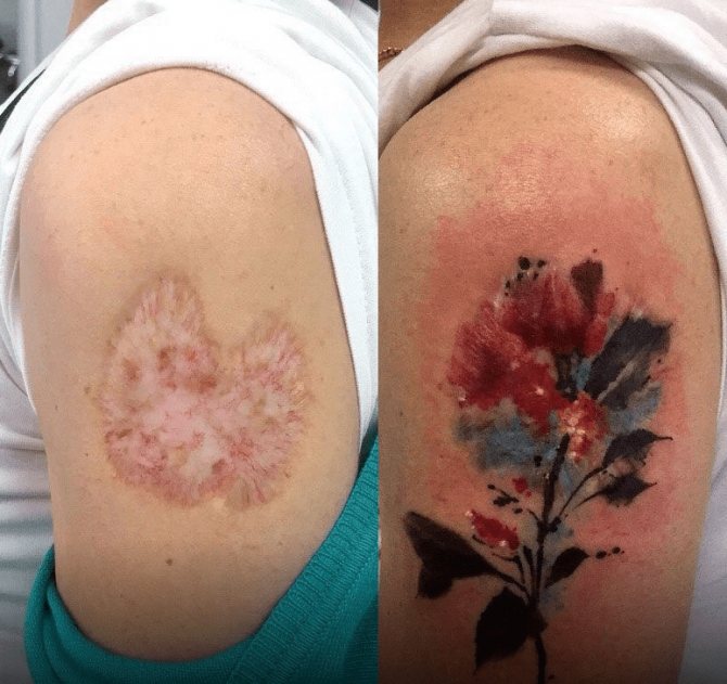 comment recouvrir une cicatrice atrophique