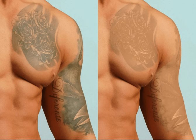Quel est le tatouage le plus facile à enlever ?