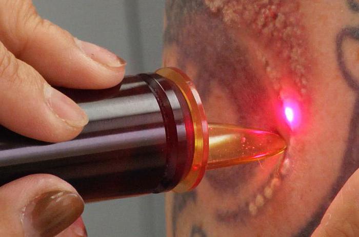 Tatoveringskorrektion efter heling