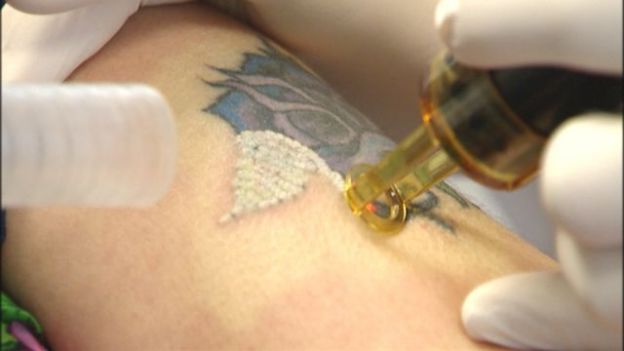 laser tatovering korrektion