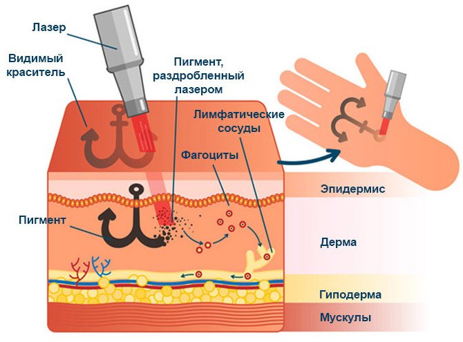 Fjernelse af tatoveringer med laser. Anmeldelser, før og efter billeder