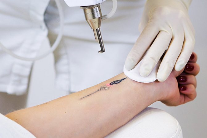 Fjernelse af tatovering med laser. Anmeldelser, før og efter billeder