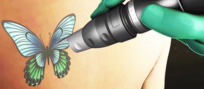 Fjernelse af tatoveringer med laser. Anmeldelser, billeder før og efter