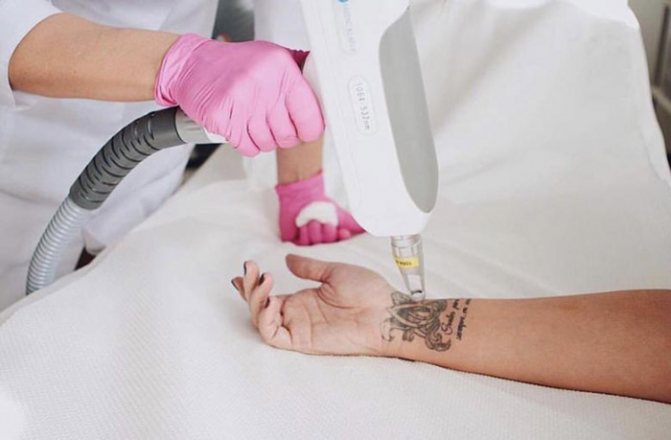 Fjernelse af tatoveringer med laser. Anmeldelser, billeder før og efter