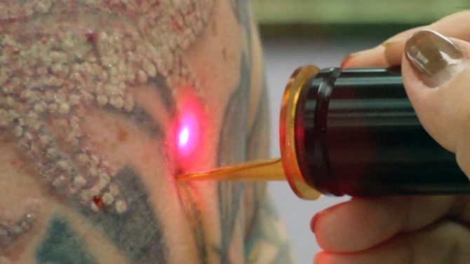 l'élimination des tatouages au laser