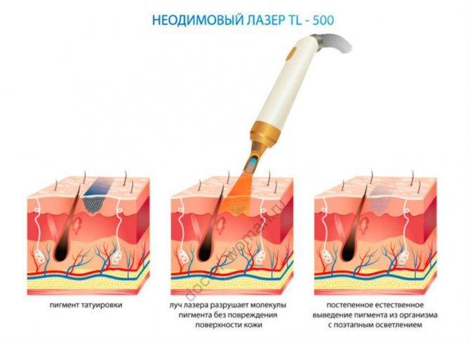 Técnica de eliminación de tatuajes