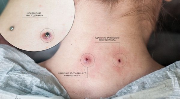 首、顔、腕、胸、鎖骨、腰のマイクロダーマル。なんだろう、ピアスの写真。作り方・直し方