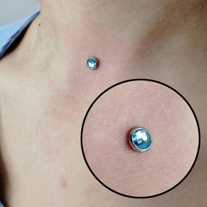 микродермален