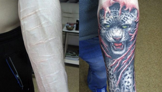 傷跡のタトゥーを入れることはできますか?カバーできるタトゥーは?質問に対する回答