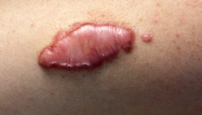 Mohu si nechat vytetovat jizvy? Která tetování lze zakrýt? Odpovědi na tyto otázky