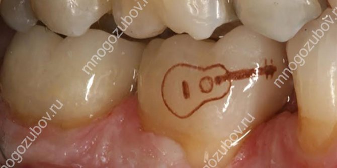 タトゥーのデメリット