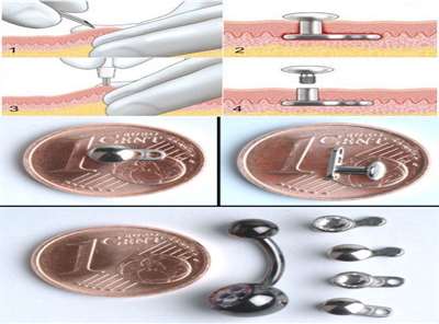Caractéristiques de la procédure