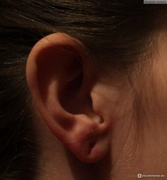 Swelling after piercing