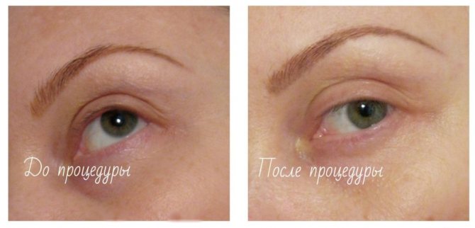 Tattoo fjernelse hævelse hævelse