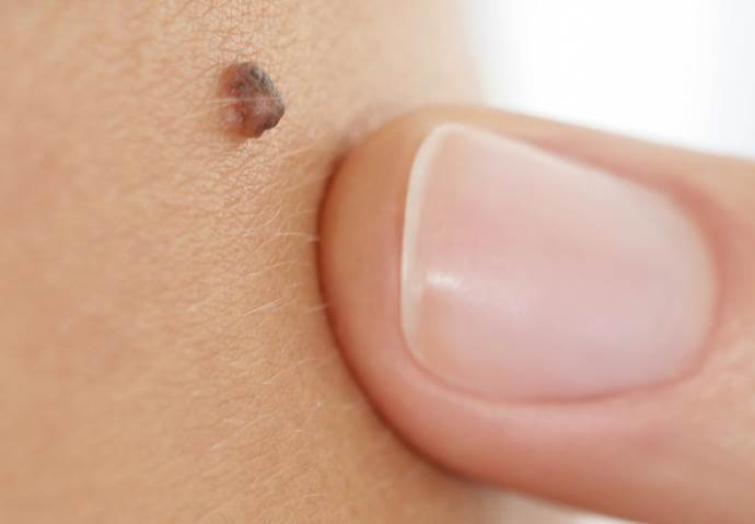 el pulgar señala una marca de nacimiento