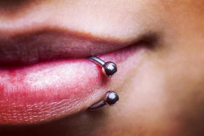 perforación del labio