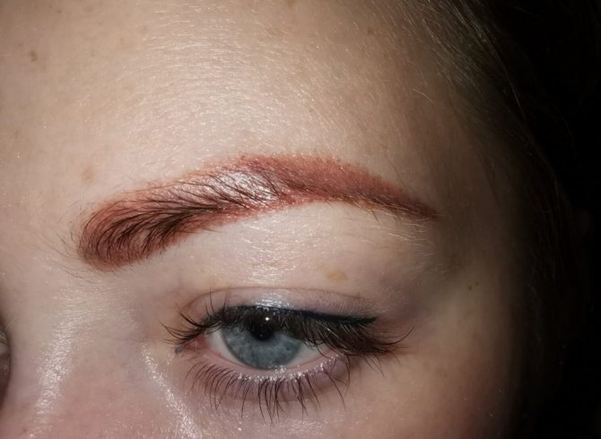 Tatovering mørknet efter laserfjernelse