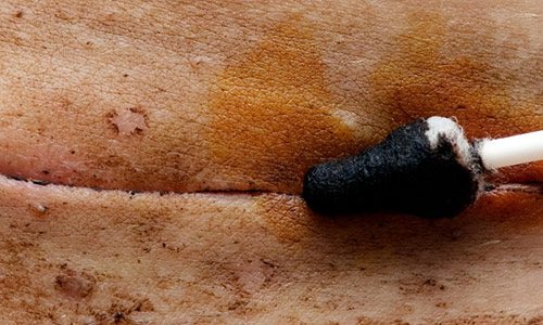 následky císařského řezu