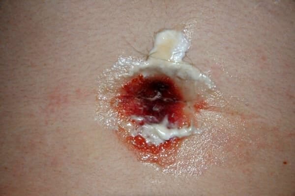 Consequences of a failed belly button piercing