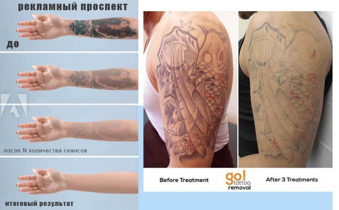 Резултат от лазерно отстраняване на татуировки