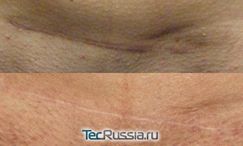 výsledky nošení silikonové náplasti na jizvě