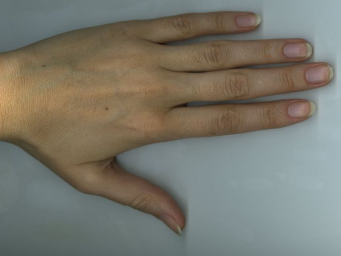 Tache de naissance sur le côté extérieur de la main