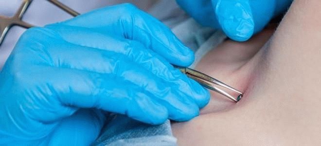 Piercing do septa - technika piercingu, výběr kroužků, náušnic a dalších šperků, zábavné fotografie naší práce