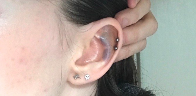 Livido dopo il piercing