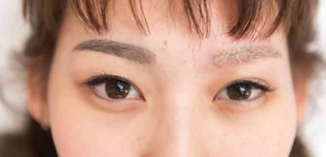 Hány kezelésre van szükség a tetoválások eltávolításához