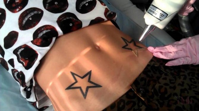 Modern laser technology can remove tattoos, but not all