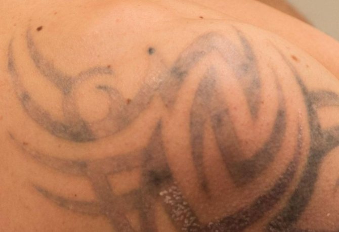Lézeres tetoválás eltávolítás