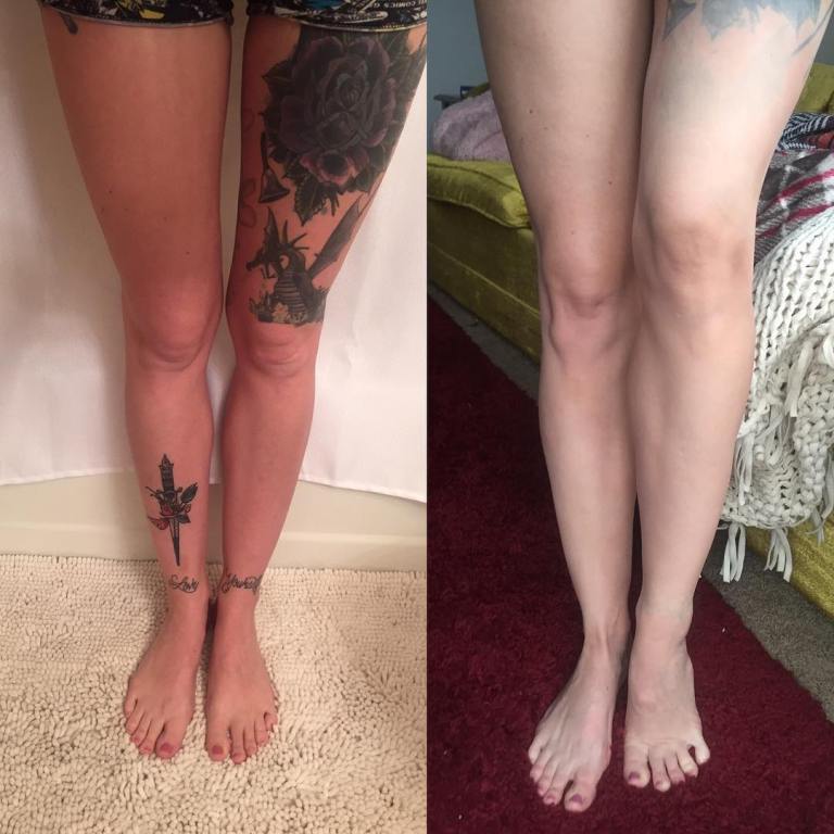 la suppression des tatouages