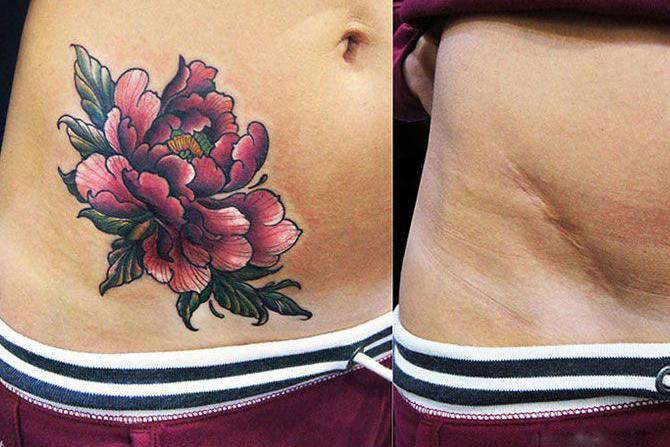 tatouage de cicatrice hypertrophique8