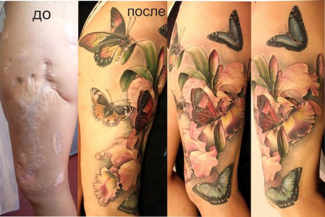 Татуировка върху изгаряне