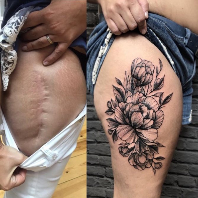 Tattoo on scars photo