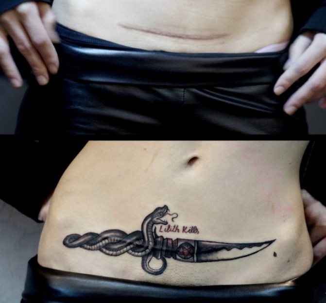 帝王切開手術後の傷跡に写真付きでタトゥー:いつからできる?