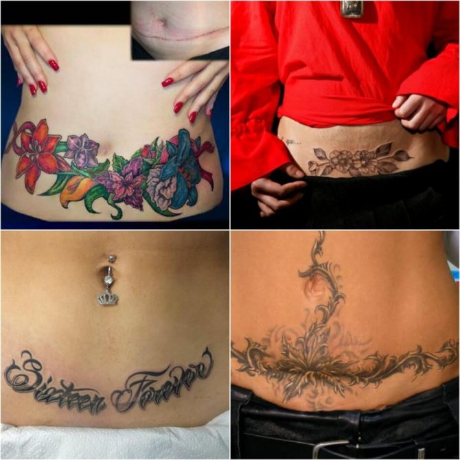 Tetování na jizvě - Tetování na jizvě po císařském řezu - Tetování na jizvě