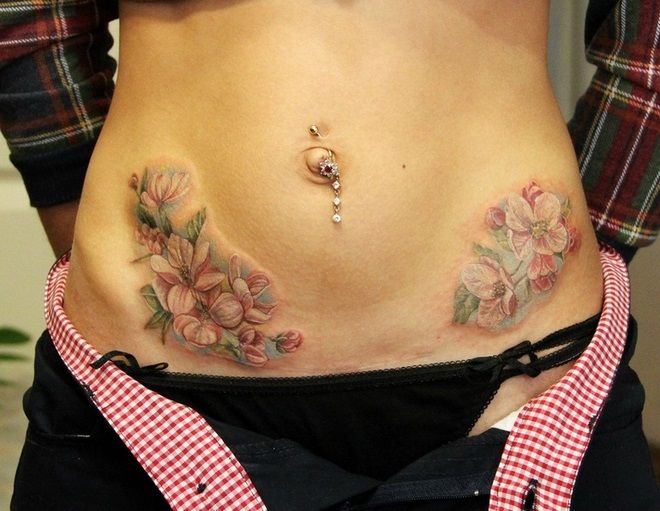 Татуировка след апендицит