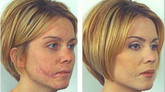 Narbentätowierung zur Anpassung an den Hautton