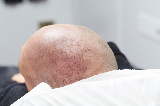 la trichopigmentation est la simulation des cheveux naturels par un tatouage